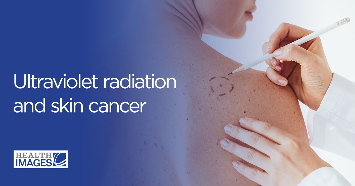 紫外线辐射和皮肤癌